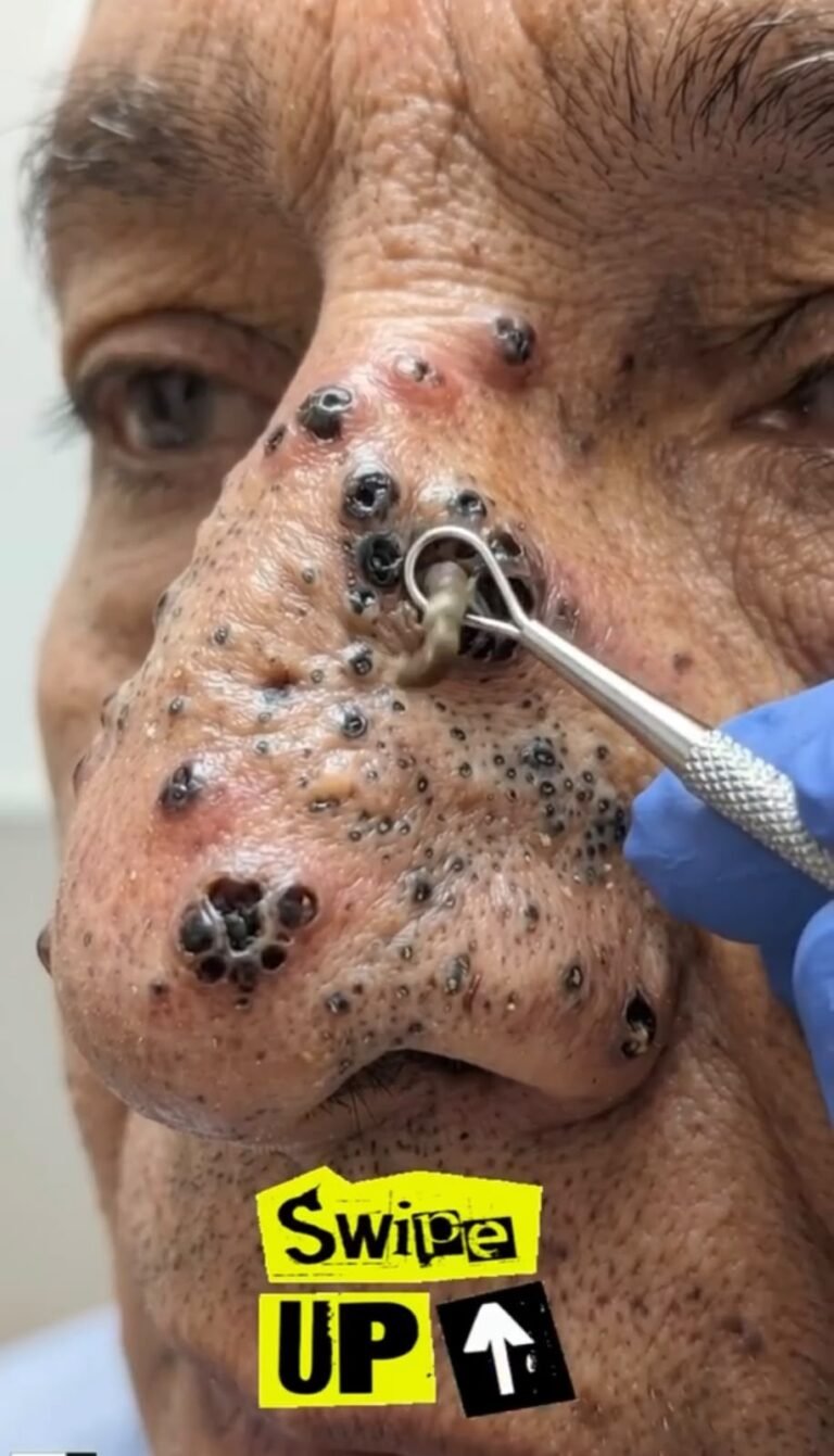 Unusual Nasal Skin Lesions: Why Multiple Blackheads and an Inflamed Spot Should Not Be Ignored