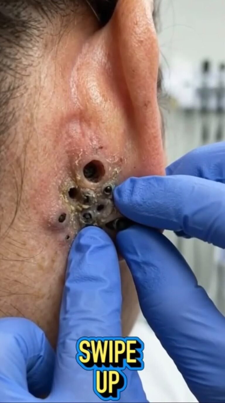 Severe Blackheads on the Nose: Why These Enlarged Pores May Need Professional Treatment
