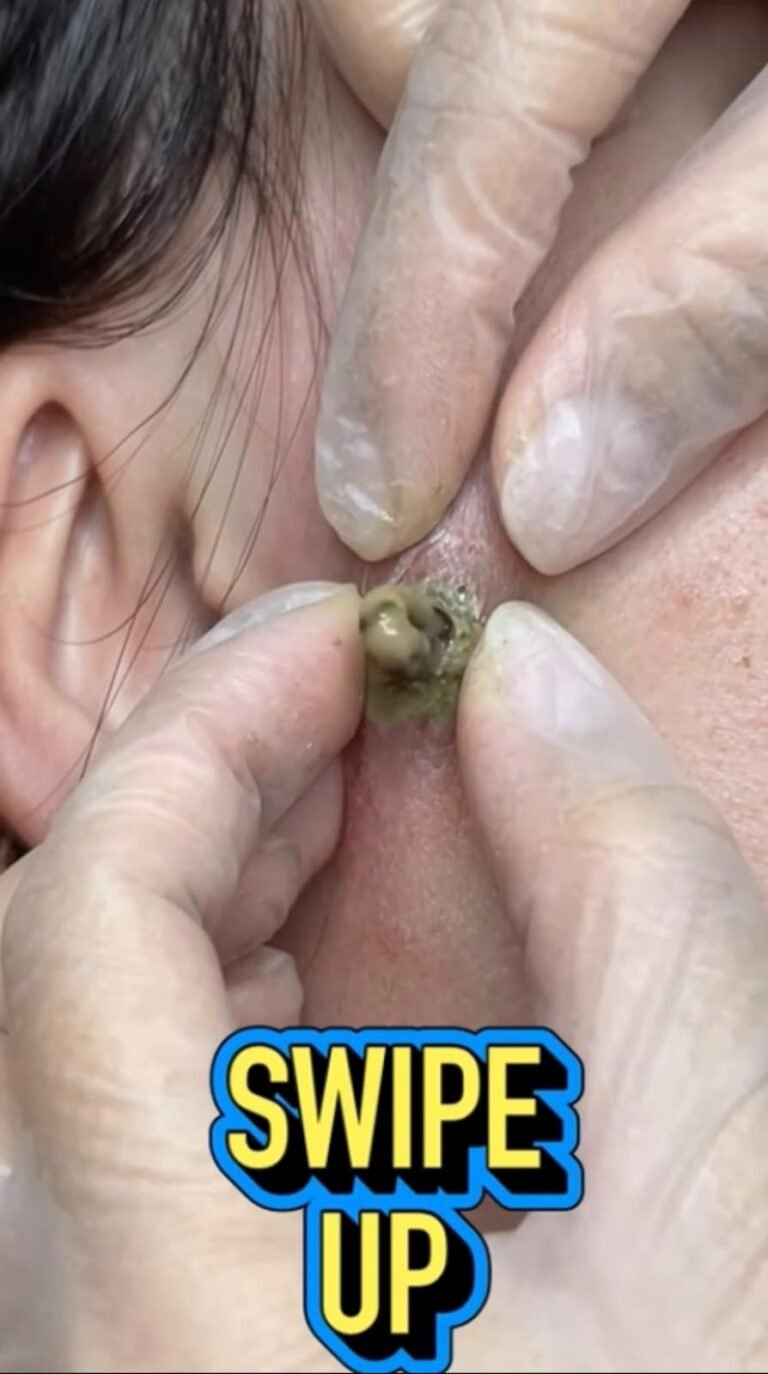 Inflamed Skin Cyst Near the Ear: What the Unusual Material May Mean