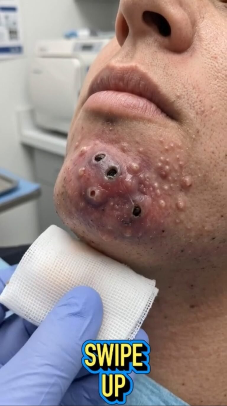 Severe Facial Breakout: Why Deep Skin Lesions Should Never Be Squeezed at Home