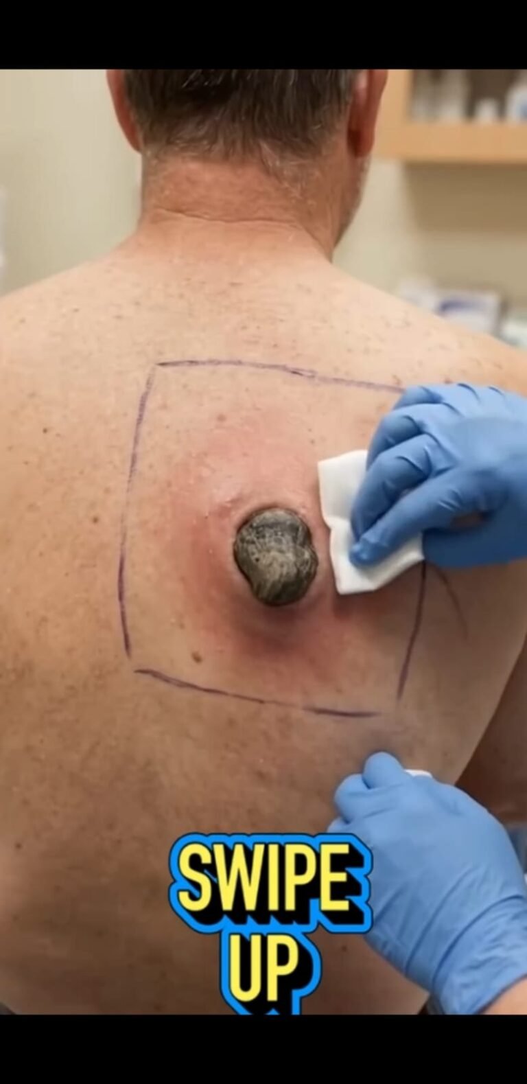 The Large Back Lump That Needed Medical Attention: Understanding Inflamed Skin Cysts