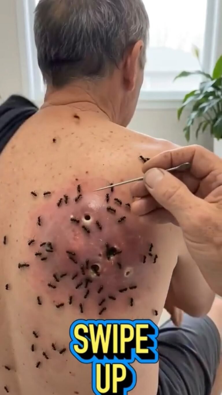 Unusual Wound Infestation: Why an Open Skin Lesion Needs Urgent Medical Care