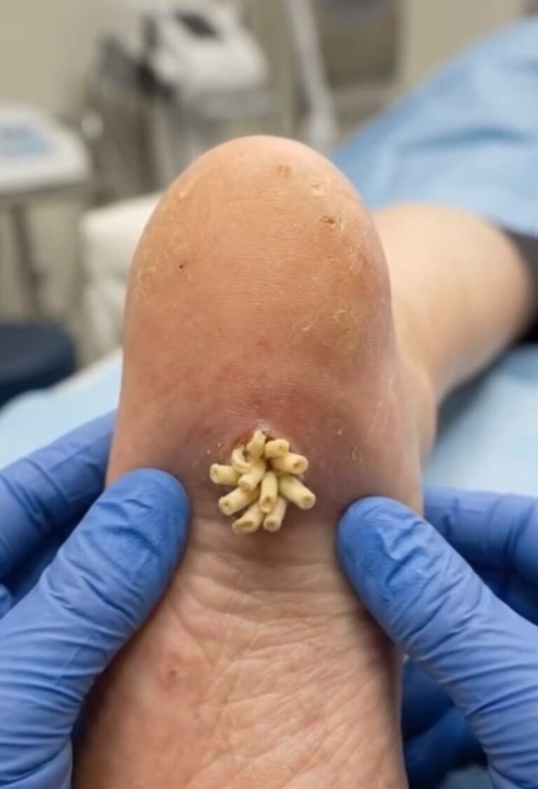 Understanding Filiform Warts: Causes, Symptoms, and Professional Treatment Options