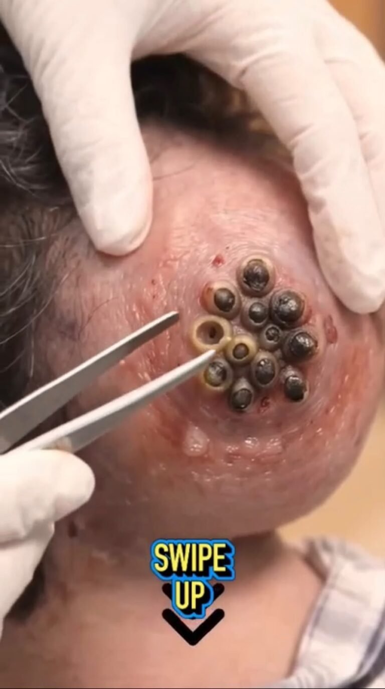 Multiple Tick-Like Parasites Around the Ear: A Medical Warning You Shouldn’t Ignore