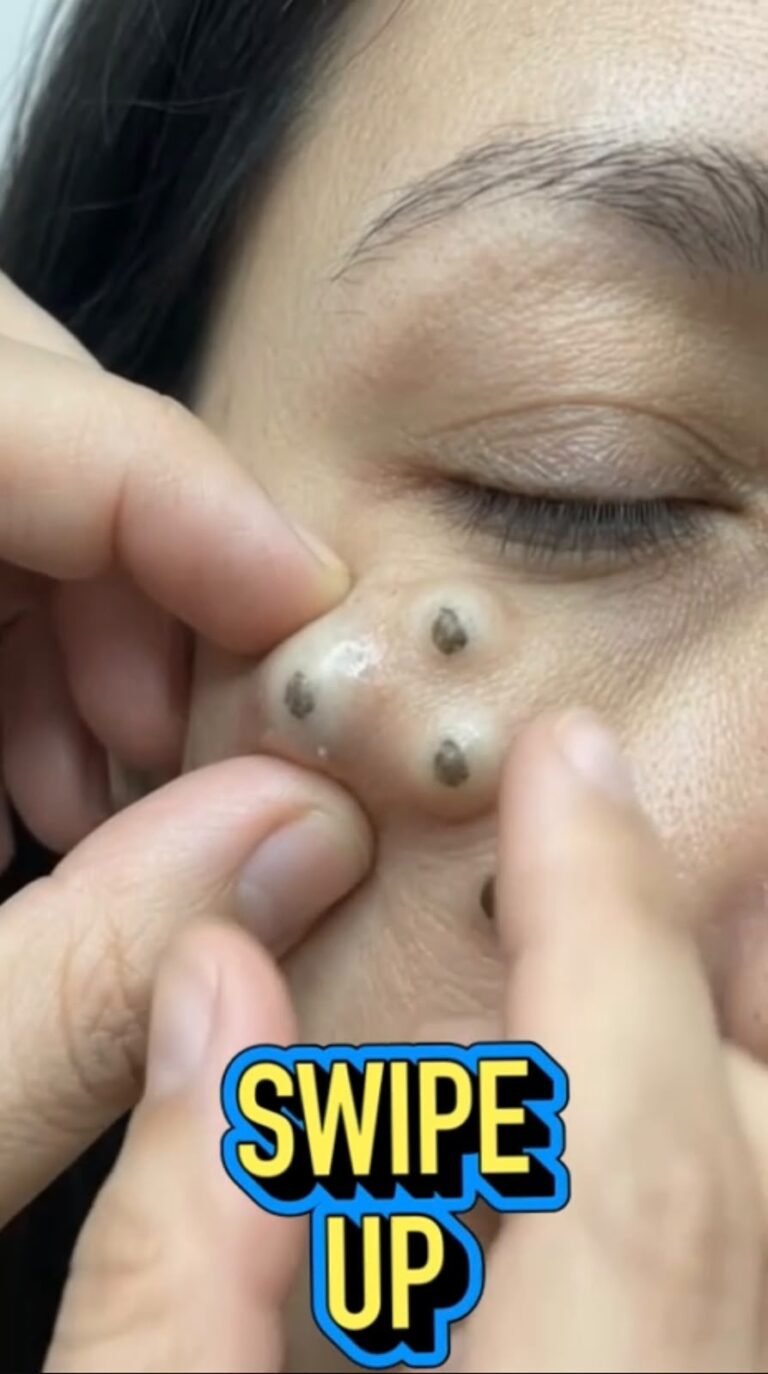 Deep Blackheads Around the Eye: What These Unusual Skin Bumps May Mean