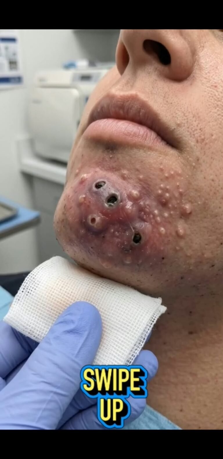 Severe Chin Acne With Large Open Pores: What This Dramatic Skin Condition May Indicate