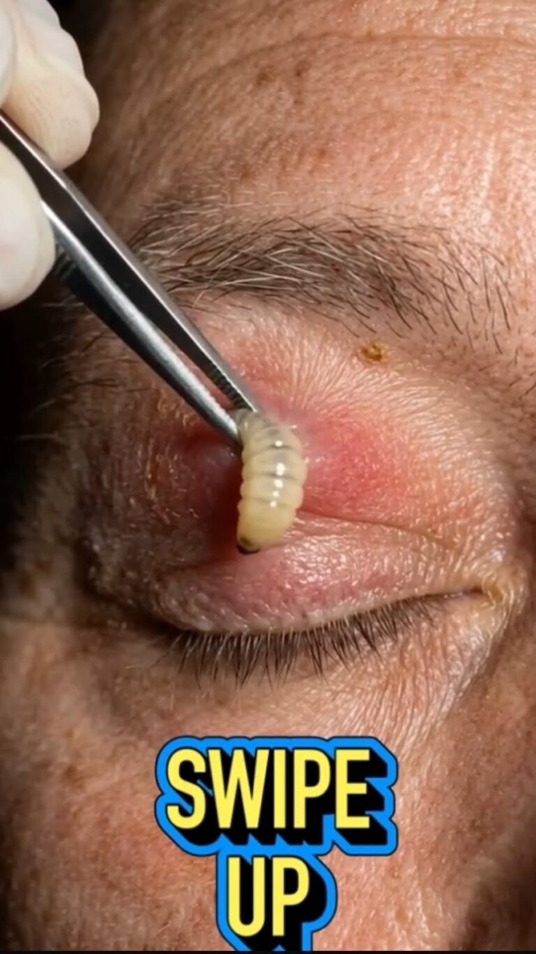 A Rare and Alarming Case: A Larva Found Near the Eyelid