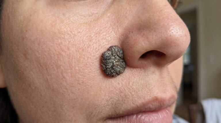 😱 A Large, Dark Skin Growth Near the Nose: What Could It Be?