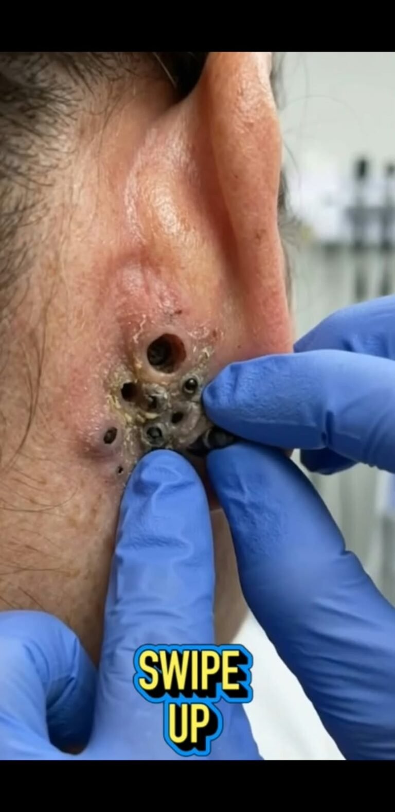 Multiple DeepBlackheads  Around the Ear: What These Unusual Skin Openings May Mean