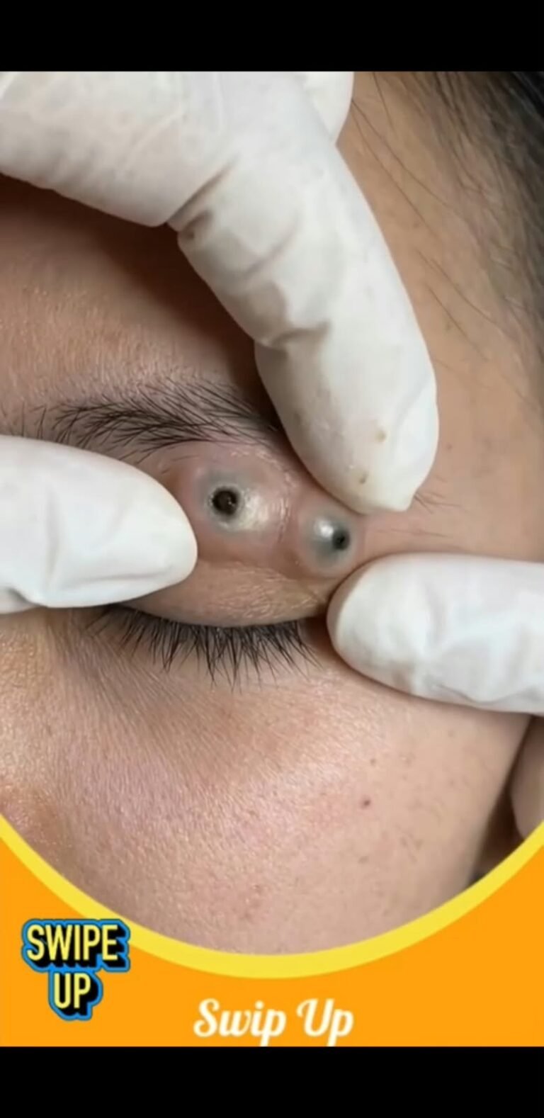 A Striking Eye-Area Skin Lesion: What Could These Dark Plugs Mean?
