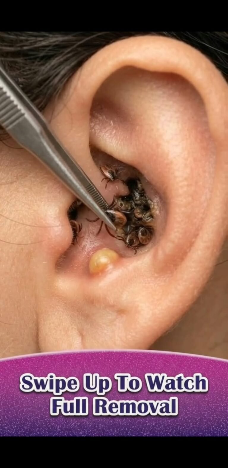 A Cluster of Ticks Inside the Ear: Why Immediate Removal Matters