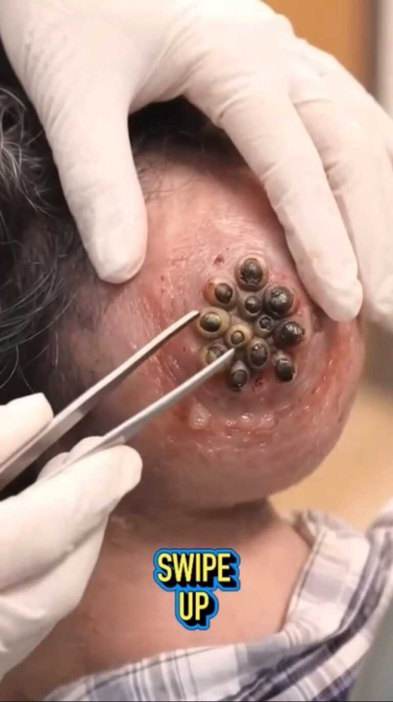 😱 Dozens of Tick-Like Parasites Clustered on the Ear: Why Immediate Removal Matters