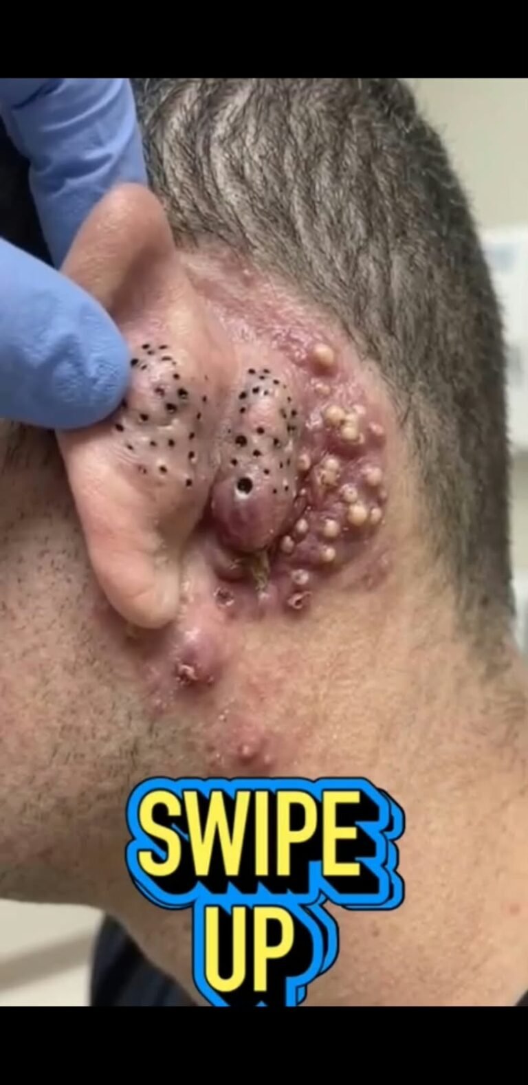 😱 Severe Ear Bumps and Deep Blackheads: What Could These Unusual Skin Lesions Mean?