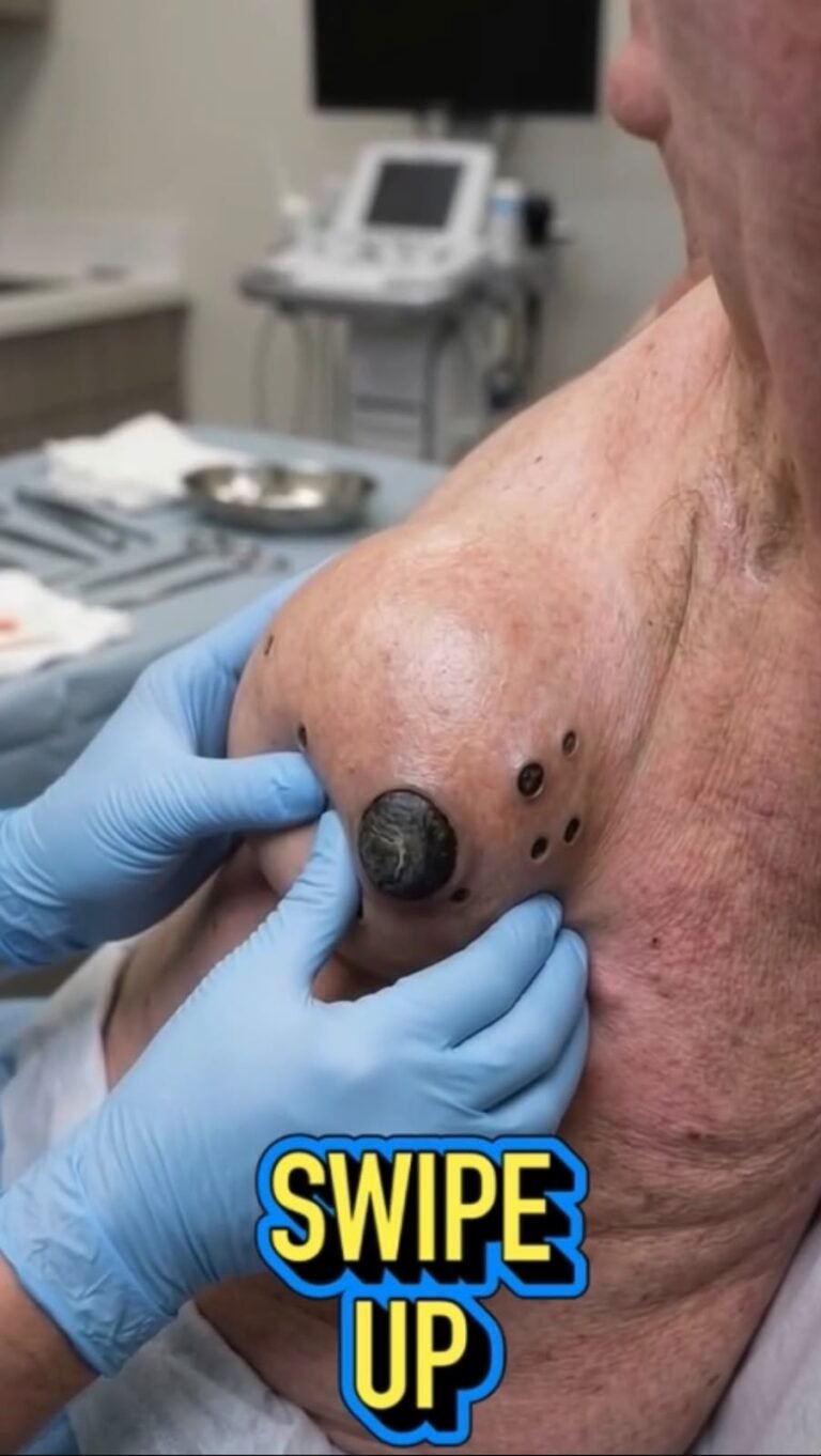 😱 A Giant Dark Growth on the Shoulder: What Could This Unusual Skin Lesion Mean?
