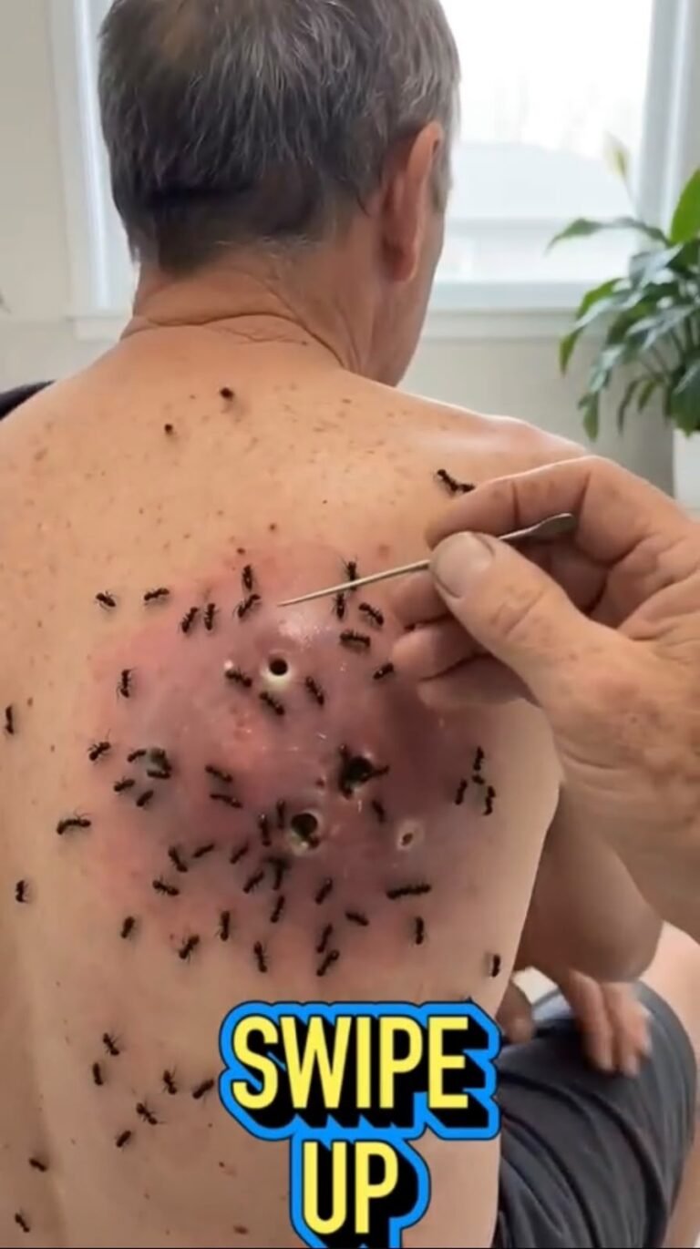 🚨 A Severe Back Skin Infection With Multiple Openings: What Could Be Happening?