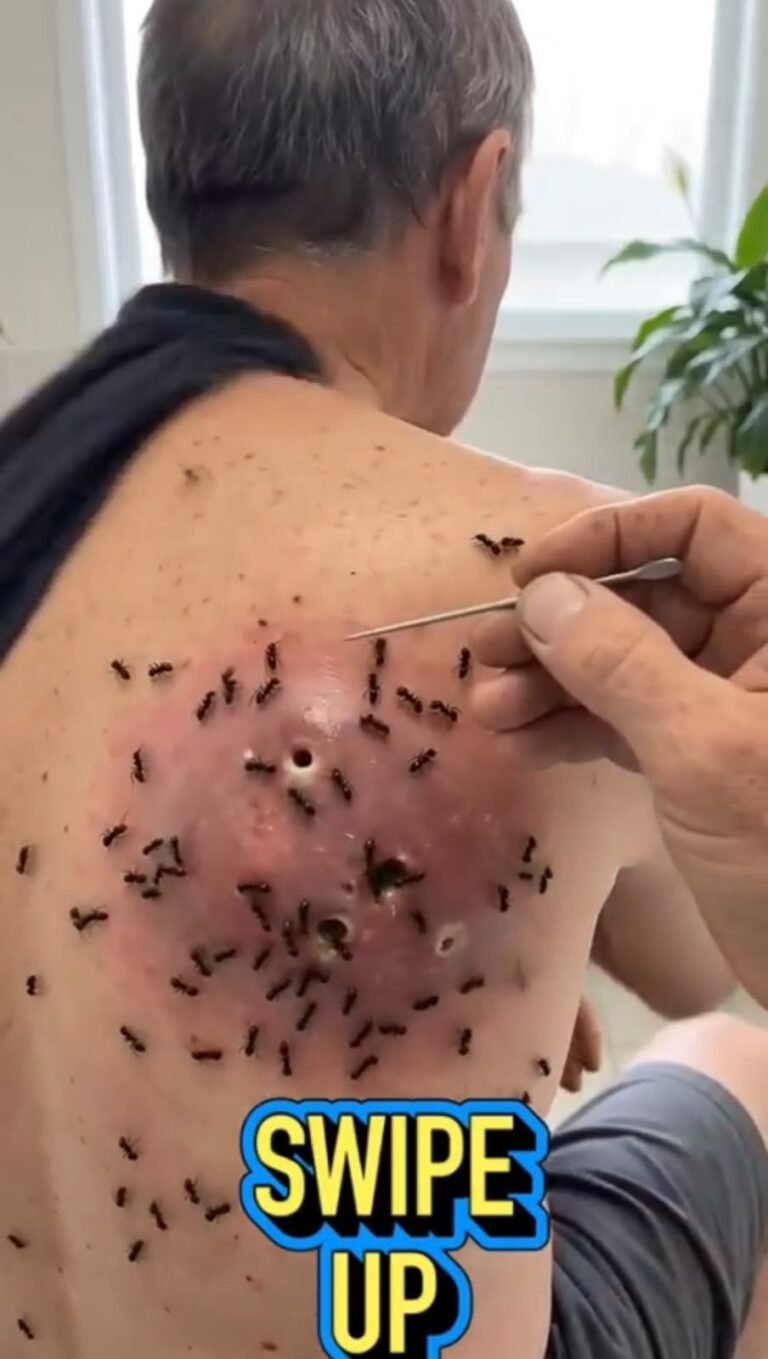 🚨 A Severe Back Wound Covered in Insect-Like Objects: What Could Be Happening?